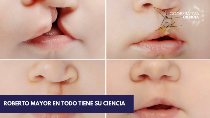 Precisan las causas que generan el labio leporino